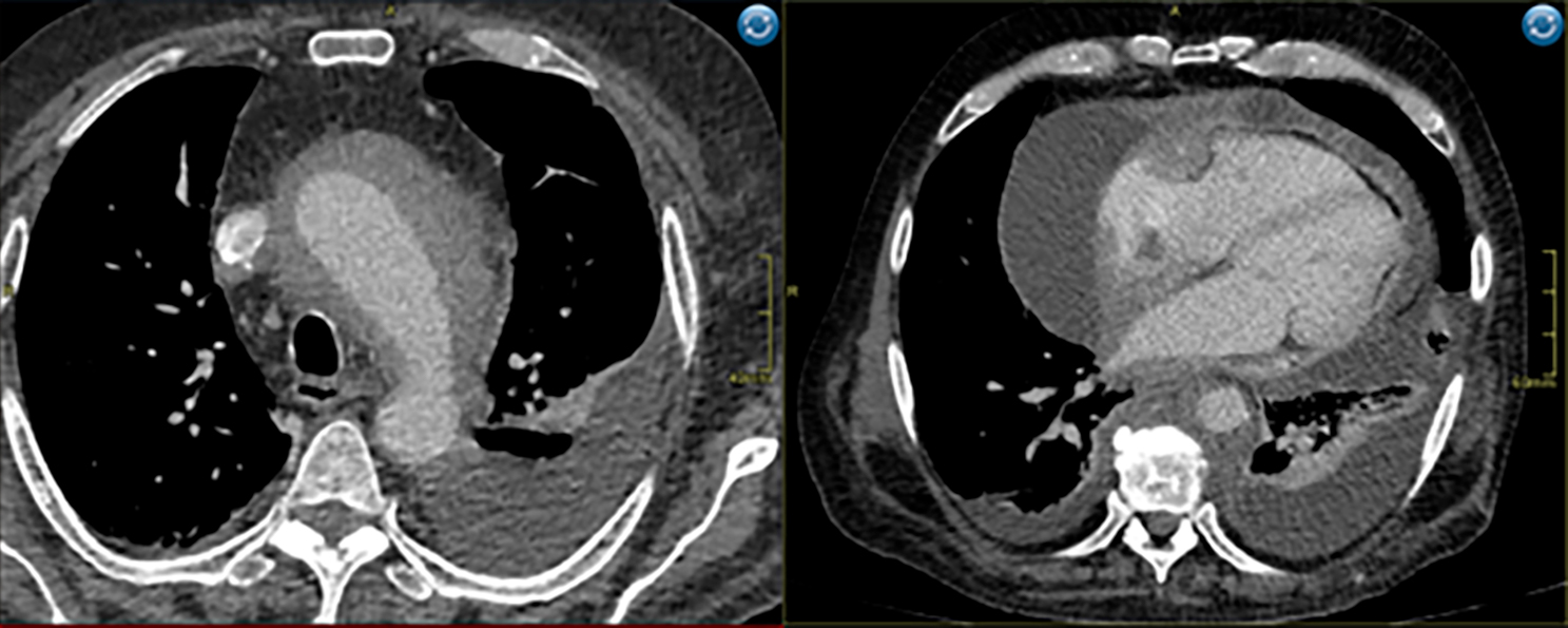 КТ ОГК Поражение аорты, перикарда и периваскулярные муфты.