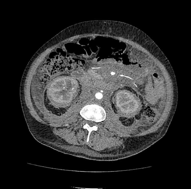 КТ брюшной полостии забрюшинного пространства