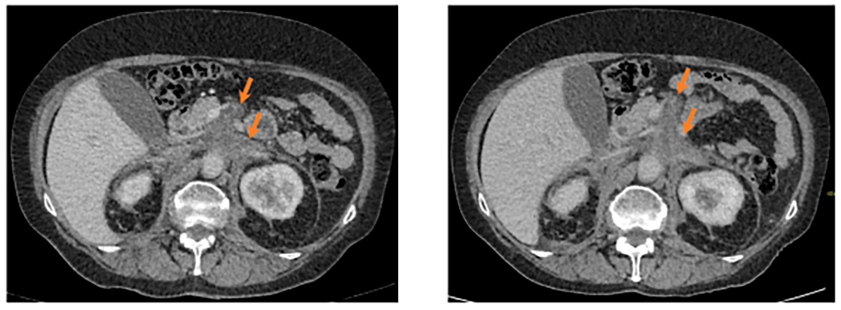 Аксиальная проекция