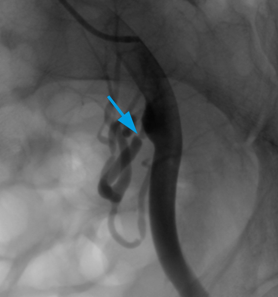 Ангиограмма стеноза в проксимальной трети почечной артерии