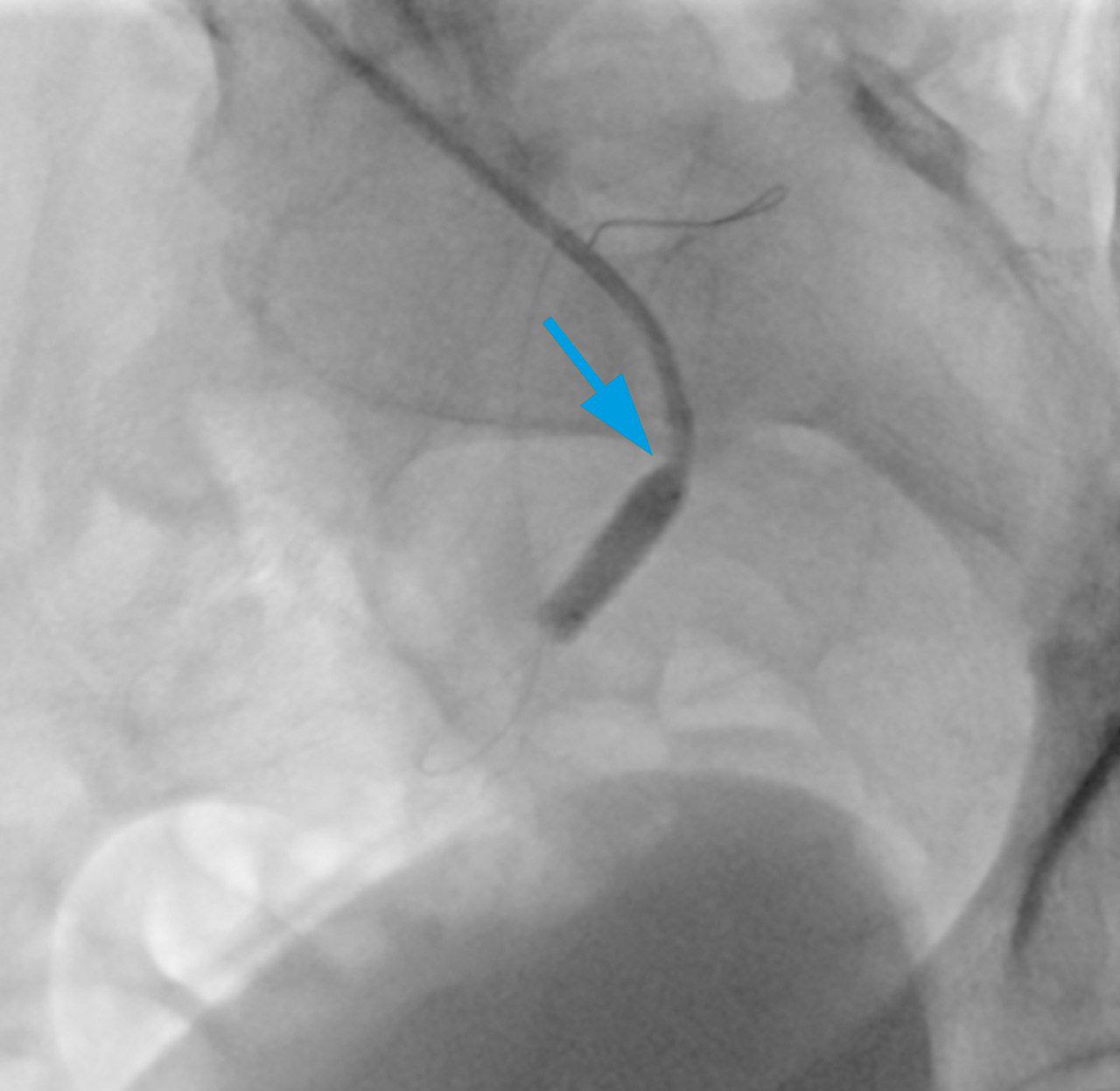 Доставка стента в почечную артерию трансплантата