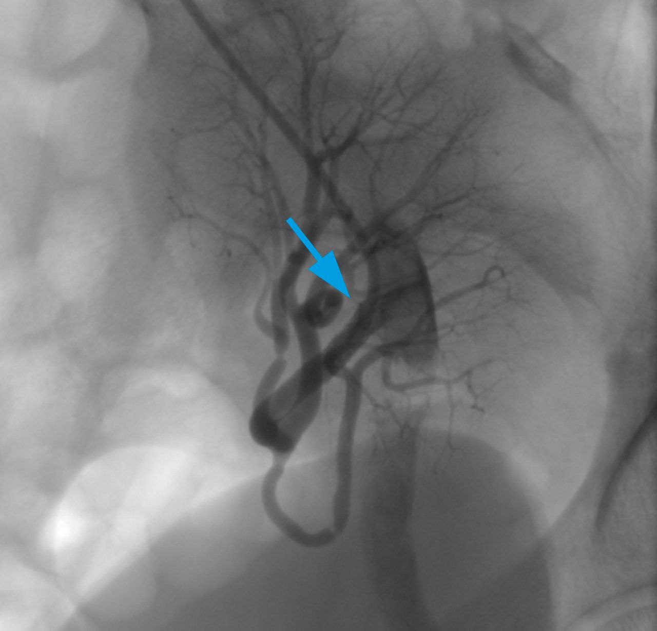 Успешный результат стентирования