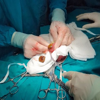 Извлеченные камни