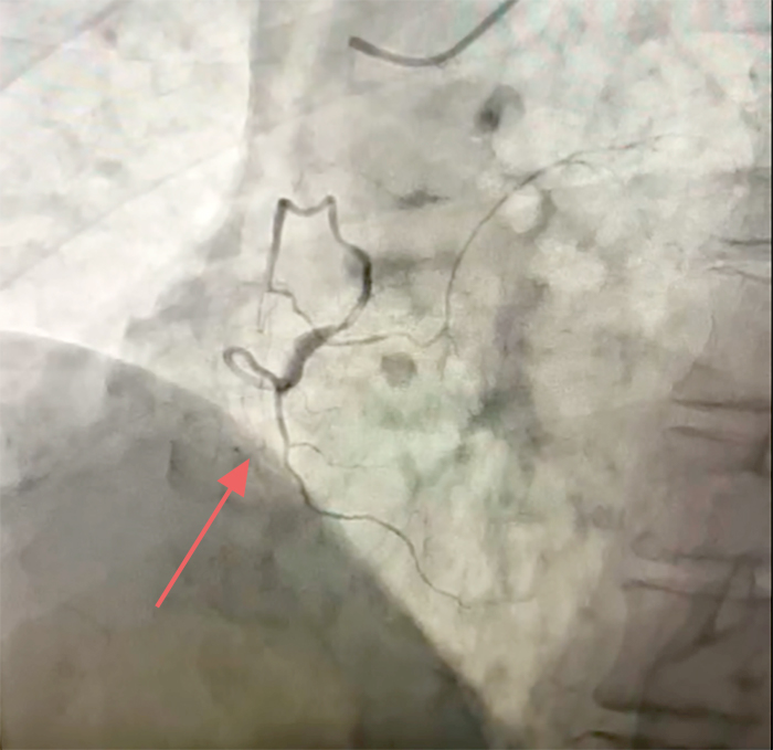  Кровоток в правой коронарной артерии отсутствует