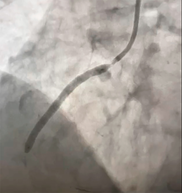 В просвет сосуда установлен стент