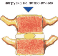 Профилактика остеохондроза грудного отдела позвоночника