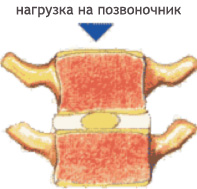 Профилактика при остеохондрозе грудного отдела позвоночника