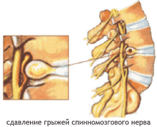 Профилактика и лечение остеохондроза шейного и грудного отдела