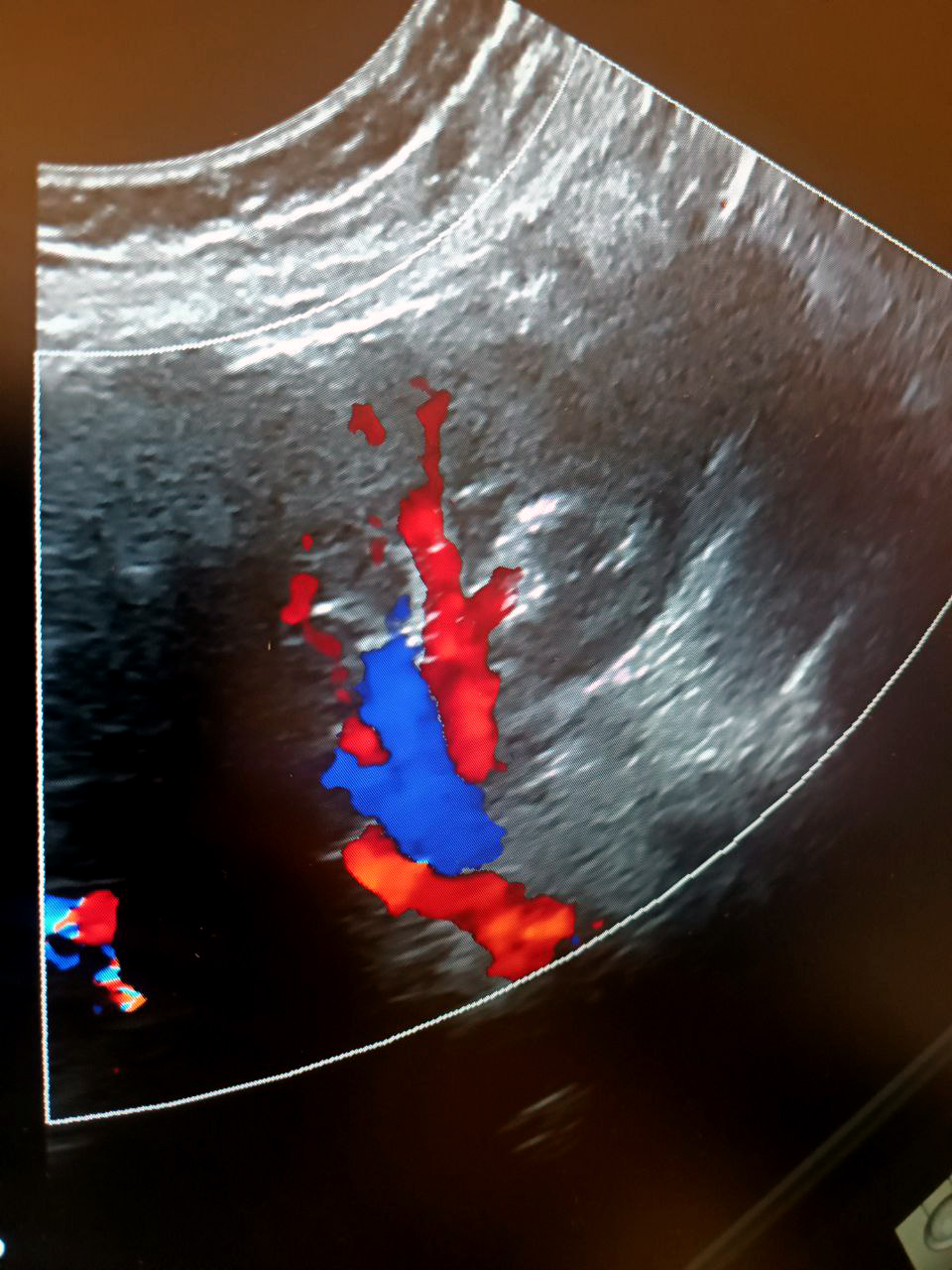 Визуализация сосудов почки